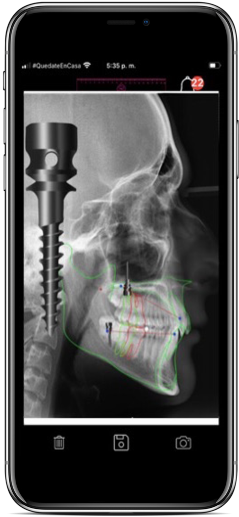 CEPH APP  By ORTHOKINETIC APPS - Lateral skull X-ray with digital orthodontic tracings and dental implant planning in the CEPH APP