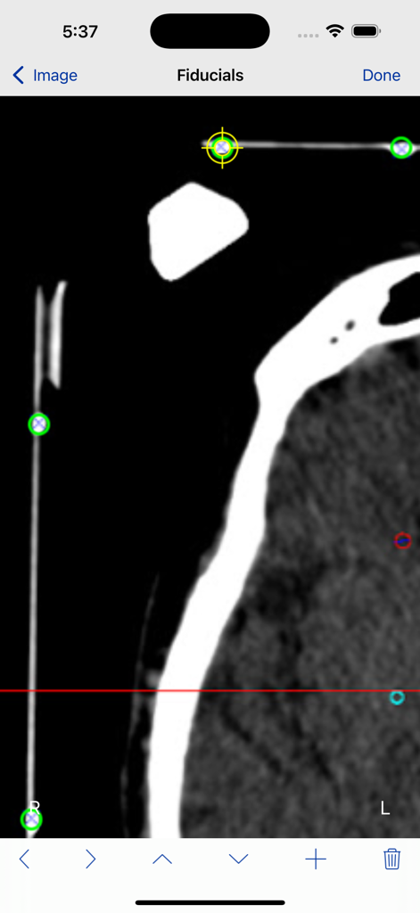StereoCheck - Interface of the StereoCheck app showing the identification of fiducial markers on a stereotactic CT scan slice