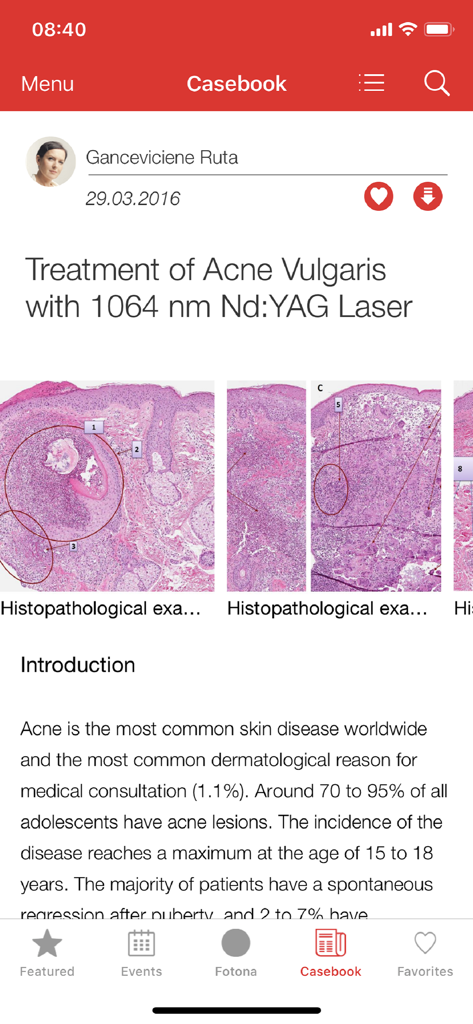 Fotona - Fotonaアプリの医療症例スタディ。Nd YAGレーザーを使用したニキビ治療を示しています。
