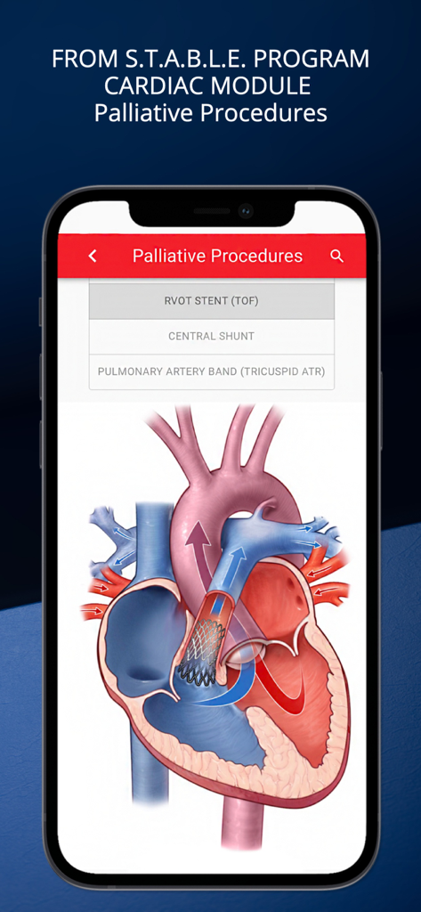 STABLEize - The STABLE Program - STABLEizeアプリのインターフェースに、ファロー四徴症の右室流出路（RVOT）ステント付き心臓解剖図を表示