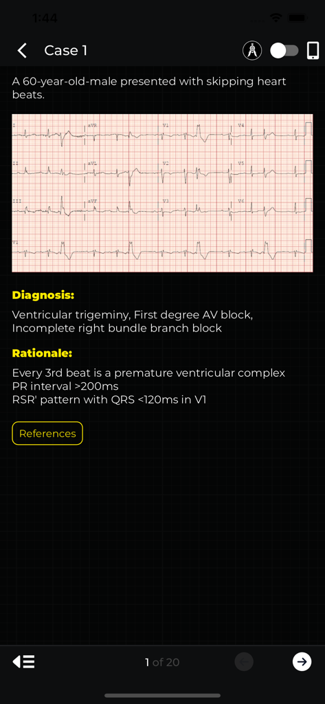 ECG Corner - A clinical case in the ECG Corner app showing an electrocardiogram strip with a detailed medical diagnosis and rationale.