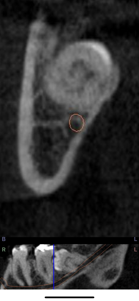 Dental CT View - Cross-section and panoramic view of a dental CBCT scan showing teeth and nerve canal