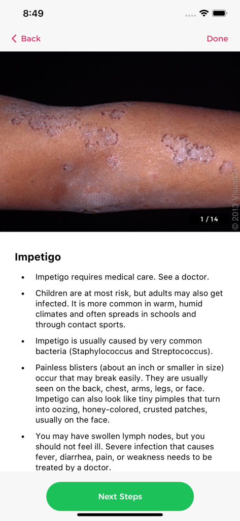 Information screen for Impetigo on the Aysa app showing symptoms and a clinical skin photo.