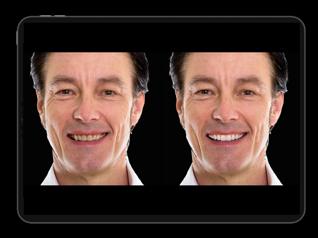 Instant Smiles - iPad에서 전후 디지털 스마일 개선 시뮬레이션