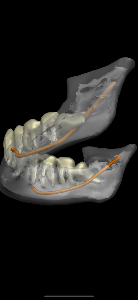 Dental CT View - A 3D anatomical render of a human mandible showing teeth and highlighted nerve canals in orange for dental implant planning