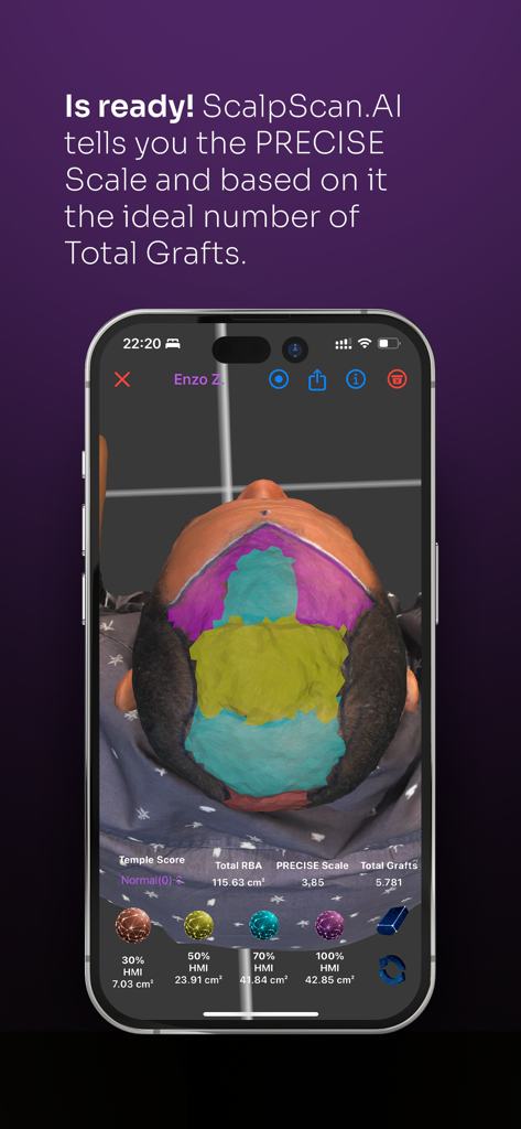 ScalpScan.AI app interface showing a 3D scalp model with hair graft calculations
