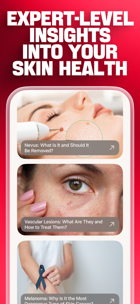 DermaScan - AI dermatologist - Una interfaz de aplicación móvil que muestra información experta sobre la salud de la piel y artículos educativos sobre nevos, lesiones vasculares y melanoma.