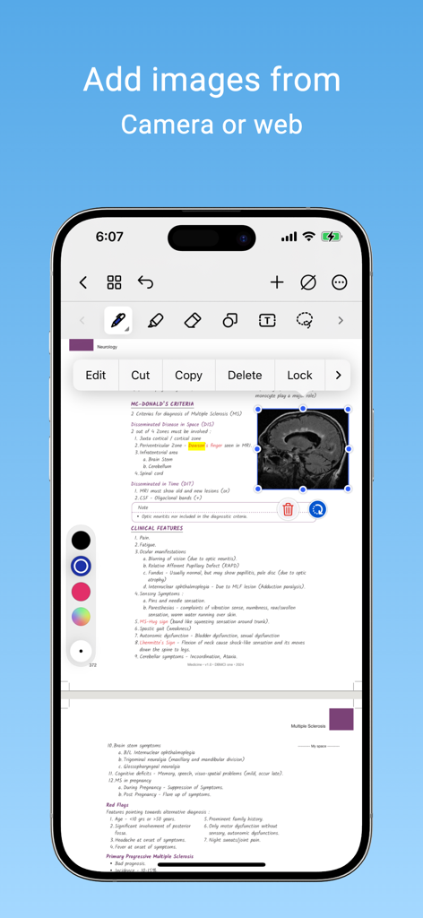 DBMCI One Notes: NEET PG, FMGE - A medical study note page in the DBMCI One Notes app with an inserted MRI brain scan.