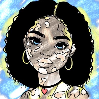 bleautiful black girl with vitiligo