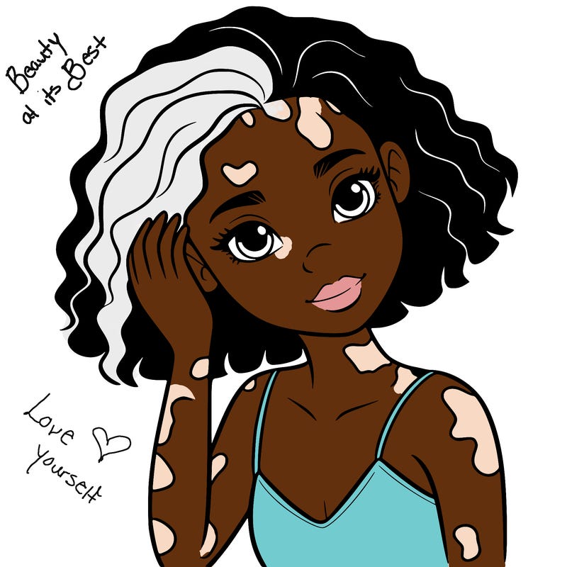vitiligo black girl