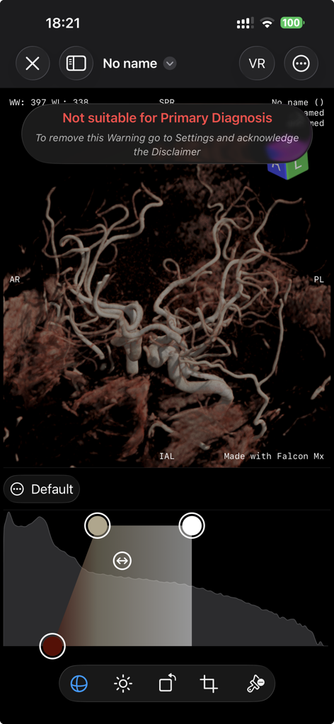 Falcon Mx - 3D photorealistic volume rendering of vascular anatomy on the Falcon Mx mobile DICOM viewer