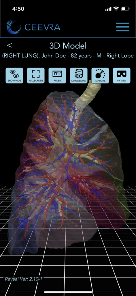 Ceevra - A 3D visualization of a lung with veins and arteries on the Ceevra medical app interface.