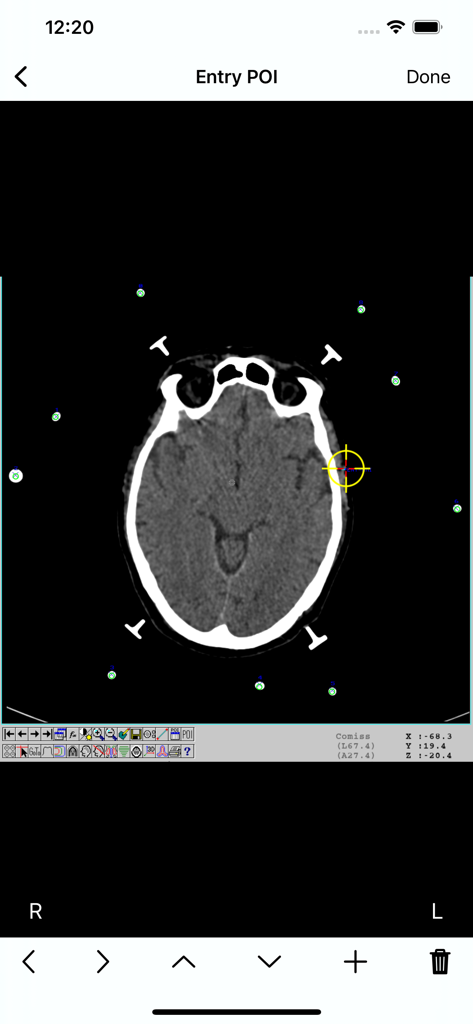 CheckBRW mobile app interface showing a brain CT scan with stereotactic fiducials and a marked entry point
