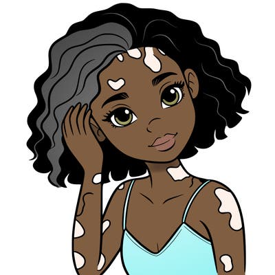 vitiligo black girl