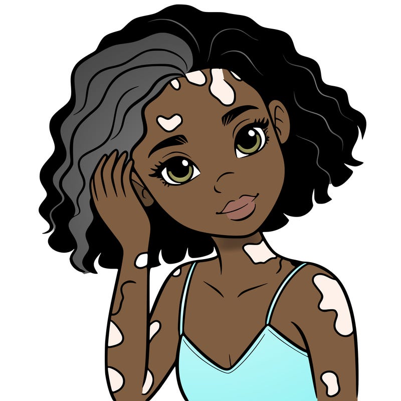 vitiligo black girl
