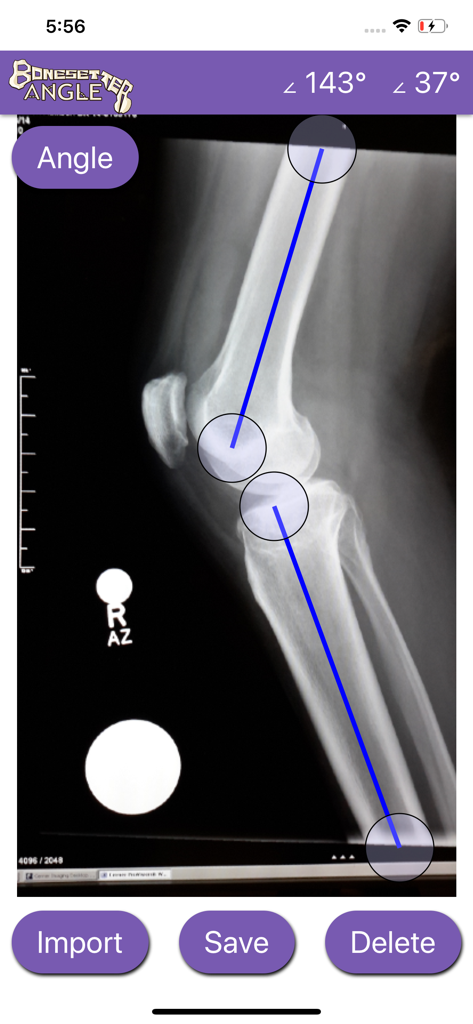 Bonesetter Angle - Bonesetter Angleアプリがレントゲン写真の膝関節角度を測定している様子