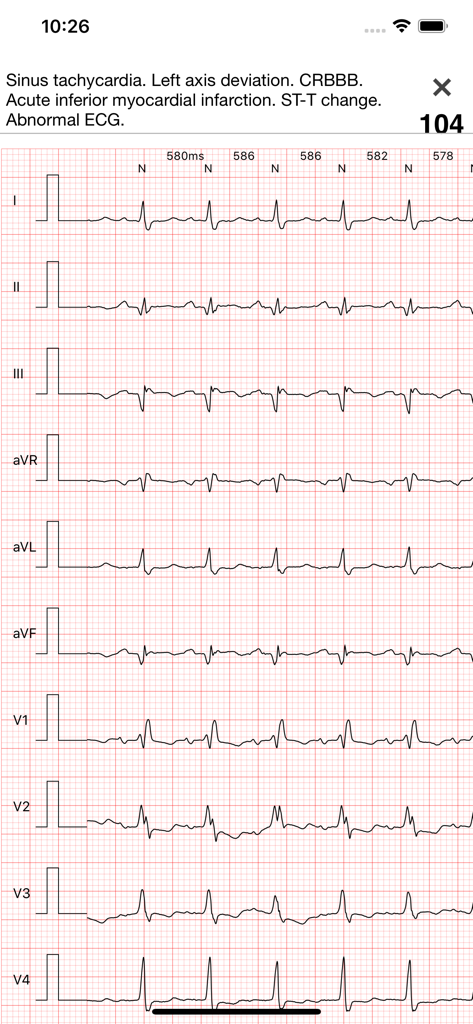 ECG Books Pro - A detailed 12-lead ECG report showing cardiac abnormalities including sinus tachycardia and myocardial infarction
