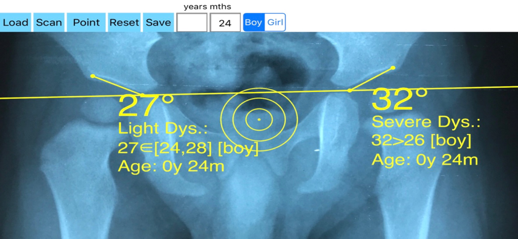 Interface of AcetabularIndex app showing hip dysplasia measurements on a pediatric X-ray