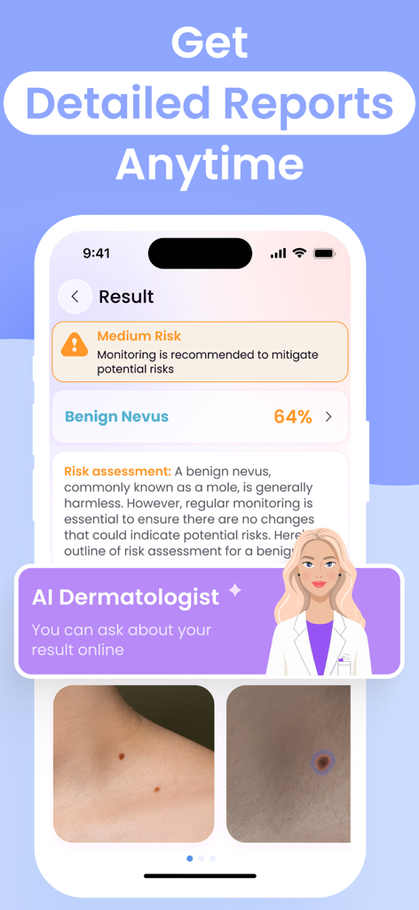 Un informe detallado de la piel de la aplicación Escáner de Piel IA que muestra una evaluación de riesgo medio para un lunar benigno nevus con fotos y una función de chat de dermatólogo IA.