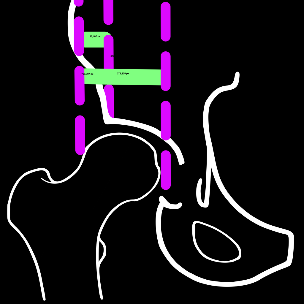 ReimersIndexApp | Hip Dysplasia & Migration Index Calculator