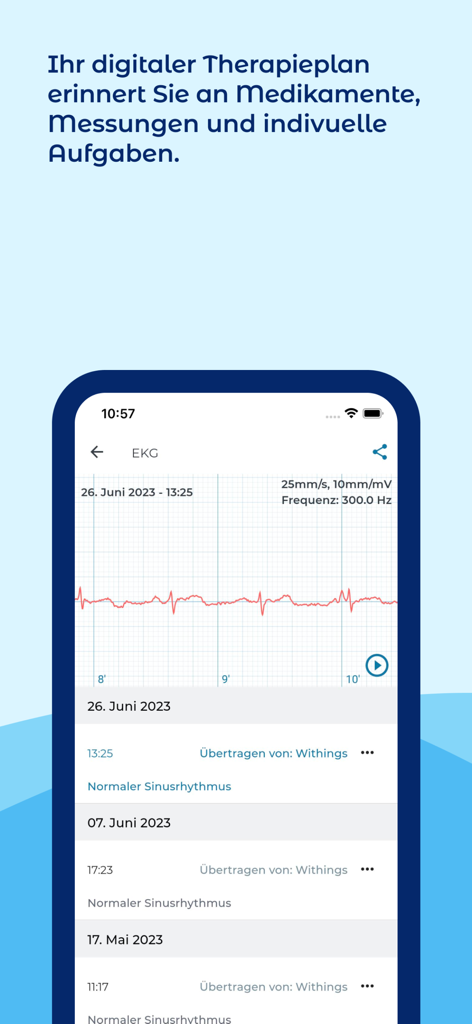 Smartphone screen showing an EKG graph and heart rhythm data in the iATROS app