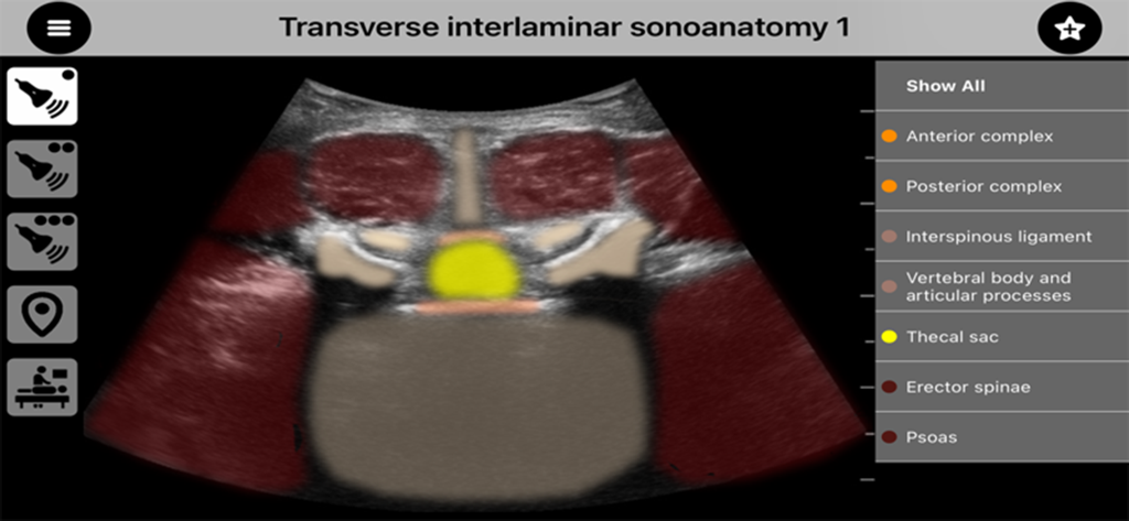 AnSo Pro - Interface do aplicativo AnSo Pro mostrando um ultrassom interlaminar transverso com sobreposições anatômicas codificadas por cores para referência clínica