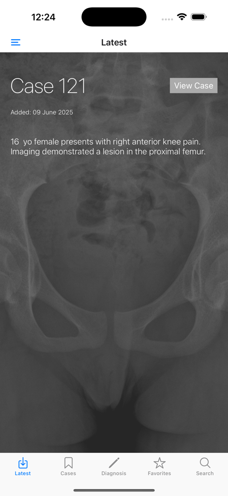 BoSTT - BoSTT app clinical case interface showing a bone tumour patient history with a background pelvic x-ray image.