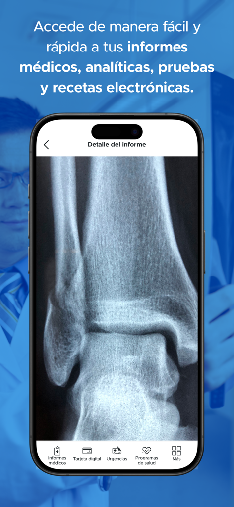 Mi Sanitas - Teléfono inteligente que muestra una radiografía de tobillo en la pantalla de detalles del informe médico de Mi Sanitas.