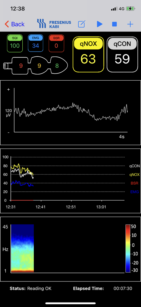 ConoxView - ConoxView app dashboard displaying real-time anesthesia depth indices and EEG signals