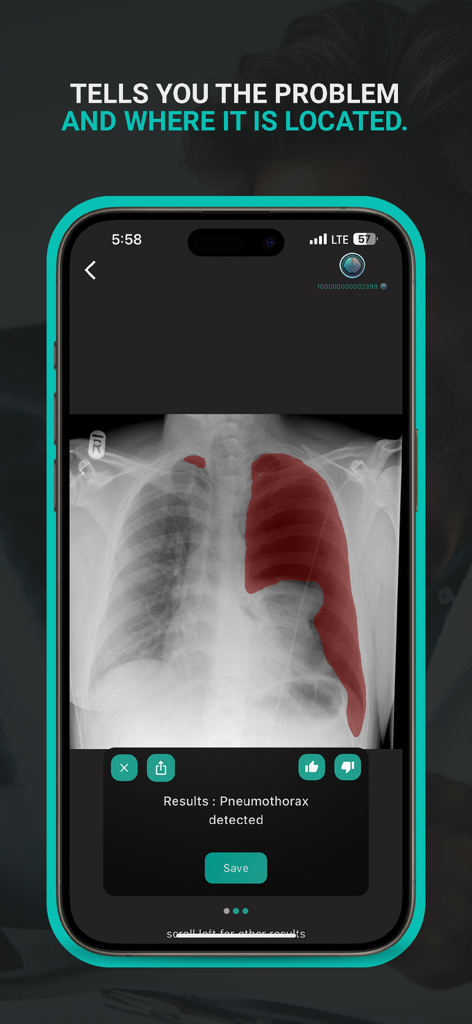 DoctorAI app interface showing a chest x-ray with a highlighted area indicating a detected pneumothorax