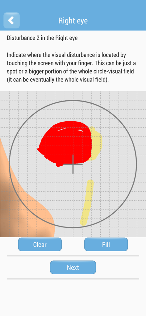 モバイルアプリの画面。円形のグリッド上に赤で手書きされた領域がある、右目の片頭痛オーラ障害の視野マッピングツールが表示されています。