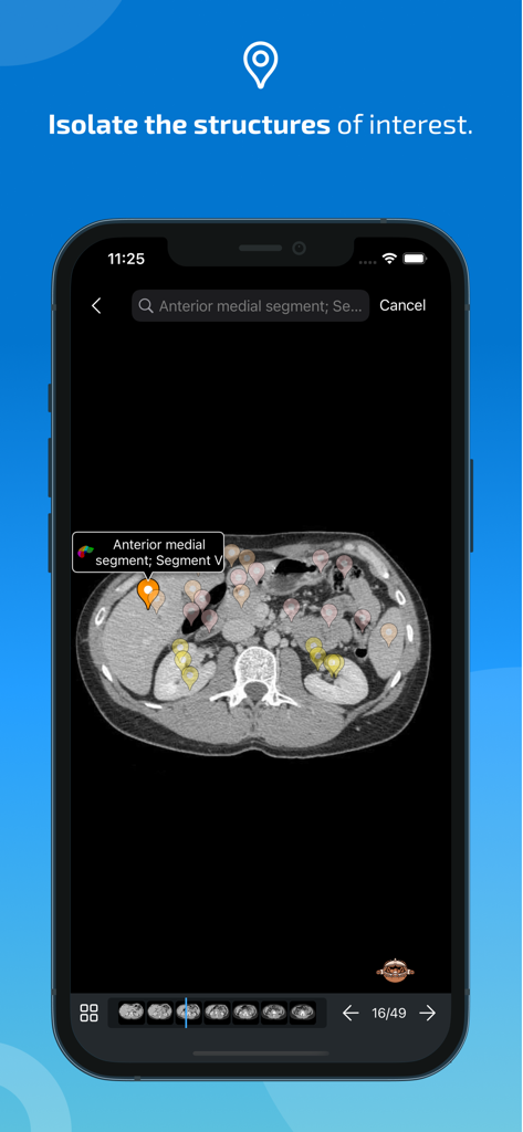 Aplicativo IMAIOS e-Anatomy exibindo um exame de TC abdominal com pinos e rótulos anatômicos destacados em uma tela de smartphone.