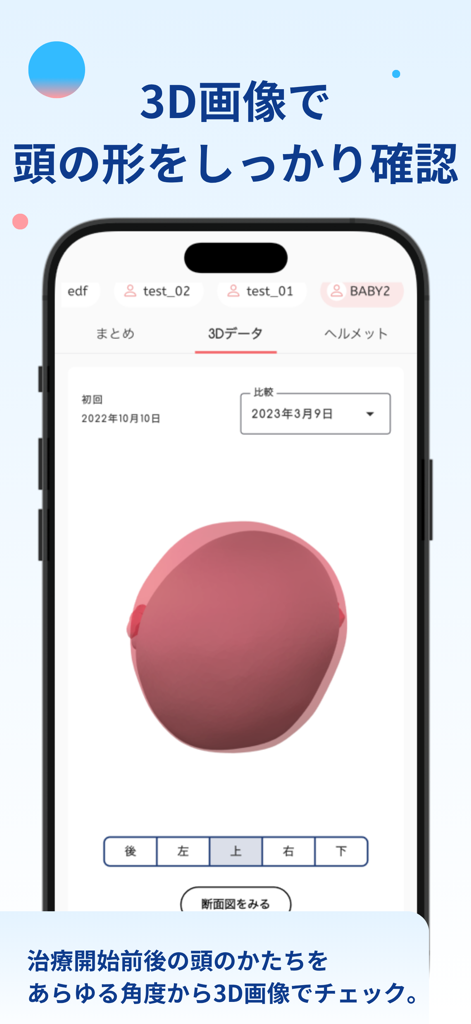 ヘルメット治療記録アプリ-babyband - ヘルメット療法中の頭蓋骨成形のリモデリングの進捗を追跡するための乳幼児の頭部の3Dモデルを示すスマートフォン画面。