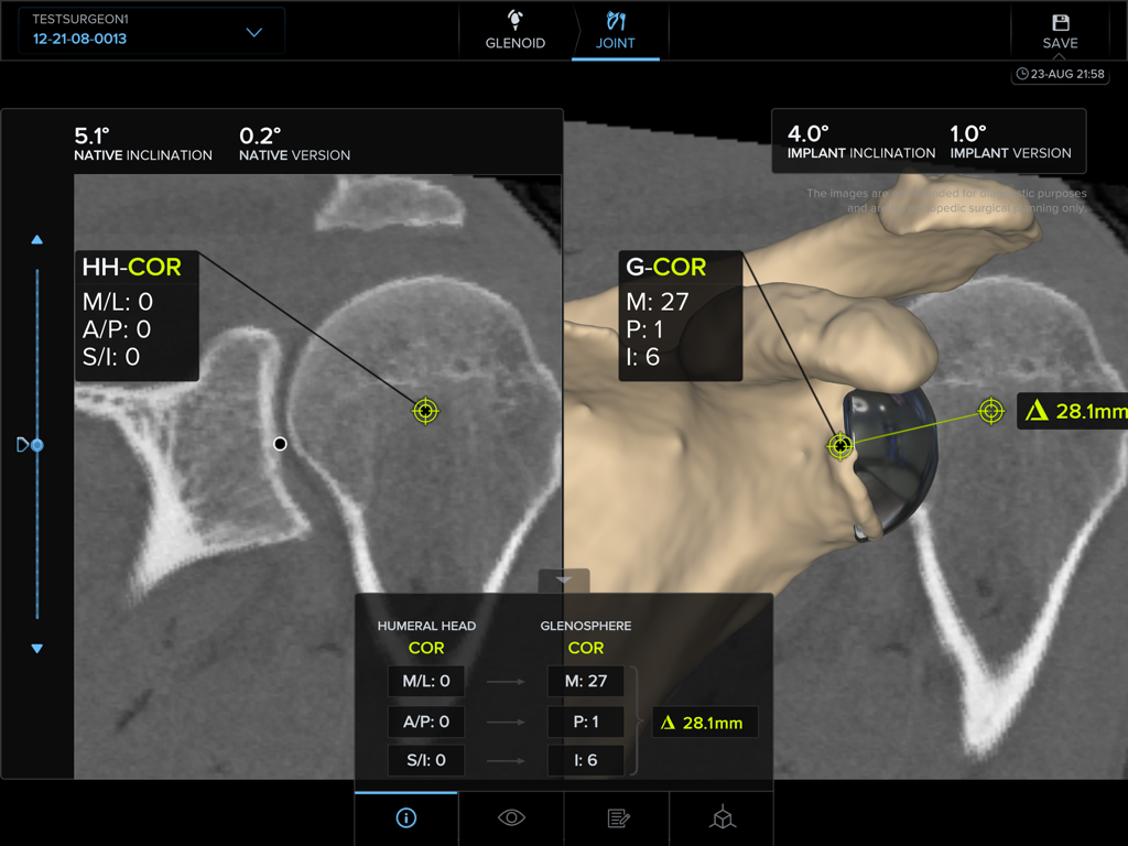 ArthrexVIP preoperative planning interface showing shoulder joint center of rotation measurements and 3D models