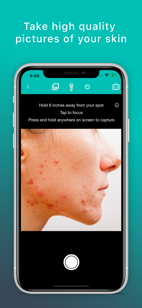 Skin App - Online Dermatology - Skin App-Oberfläche, die eine Nahaufnahme von Akne zeigt, die für eine dermatologische Konsultation aufgenommen wird.