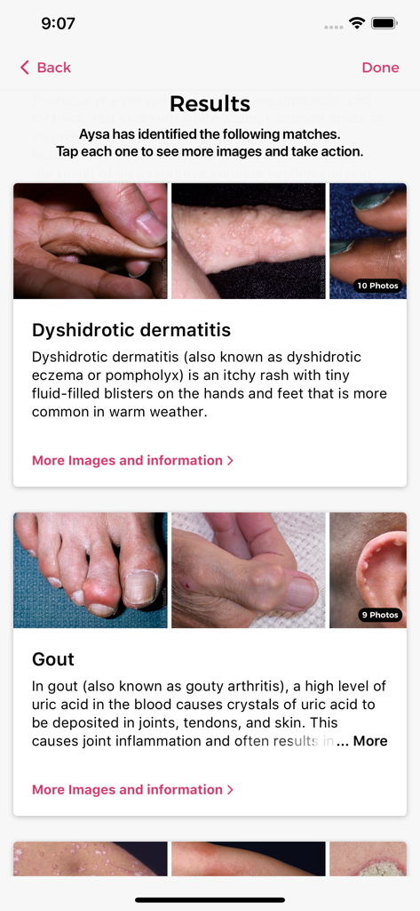 Aysa mobile app results screen displaying identified skin condition matches including dyshidrotic dermatitis and gout with clinical reference photos.