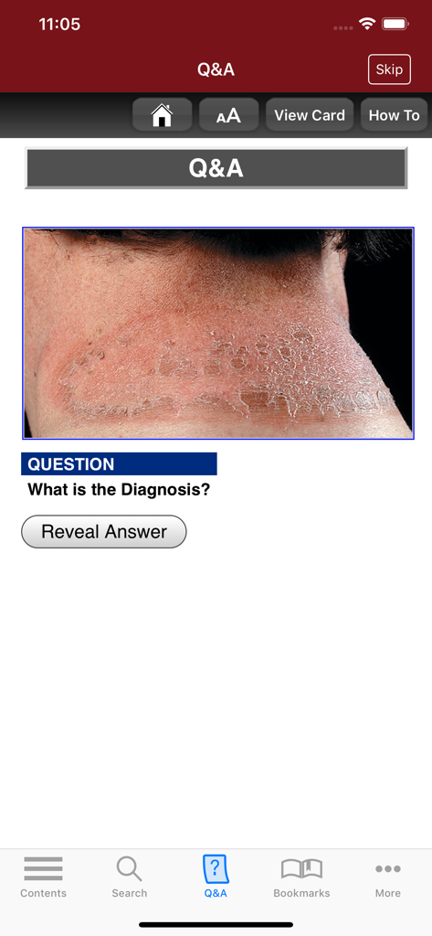 Fitzpatrick's Derm Flash Cards - Dermatologie-Karteikarten-App, die eine Quizfrage mit einem klinischen Bild einer Hauterkrankung am Hals eines Patienten anzeigt