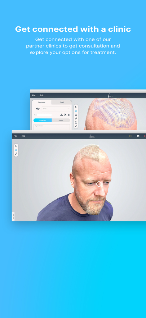 Interface de l'application Force HT Pro montrant un modèle 3D du cuir chevelu pour la planification de greffe de cheveux et la consultation en clinique.