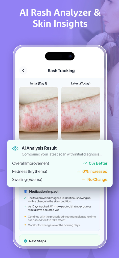 Interface of the Rash Scan app showing AI analysis results and progress tracking for a skin rash with before and after photo comparison