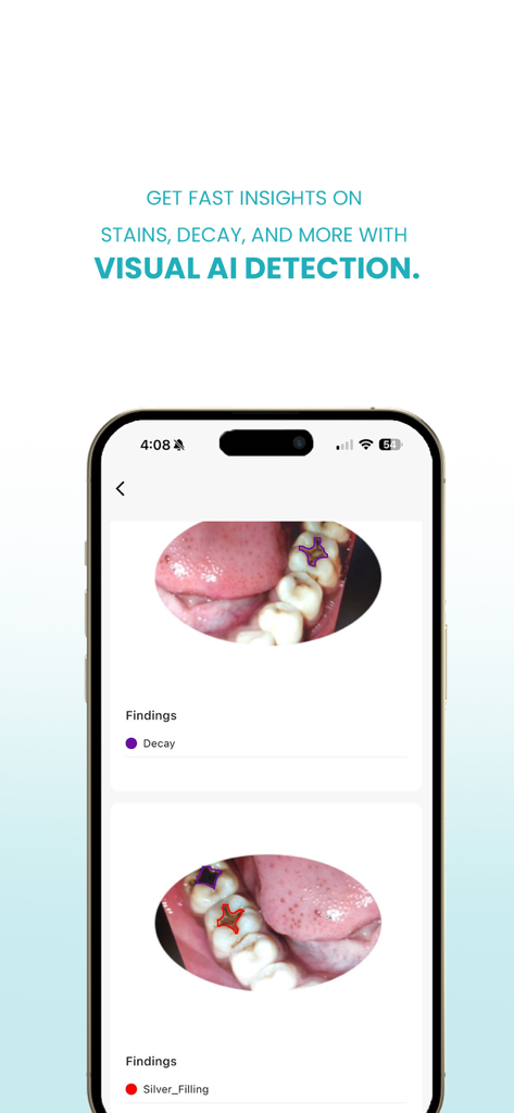 DentaSmart - Smartphone affichant l'application DentaSmart utilisant l'IA visuelle pour identifier la carie dentaire et les plombages à partir de photos.