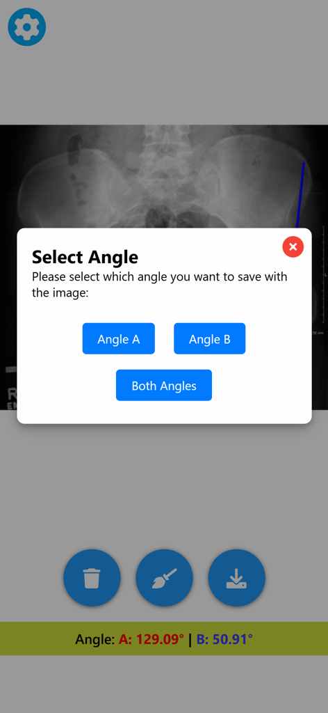 Angle Meter & Cobb Angle Meter - Interface of the Angle Meter app showing a medical X-ray with options to save measured angles