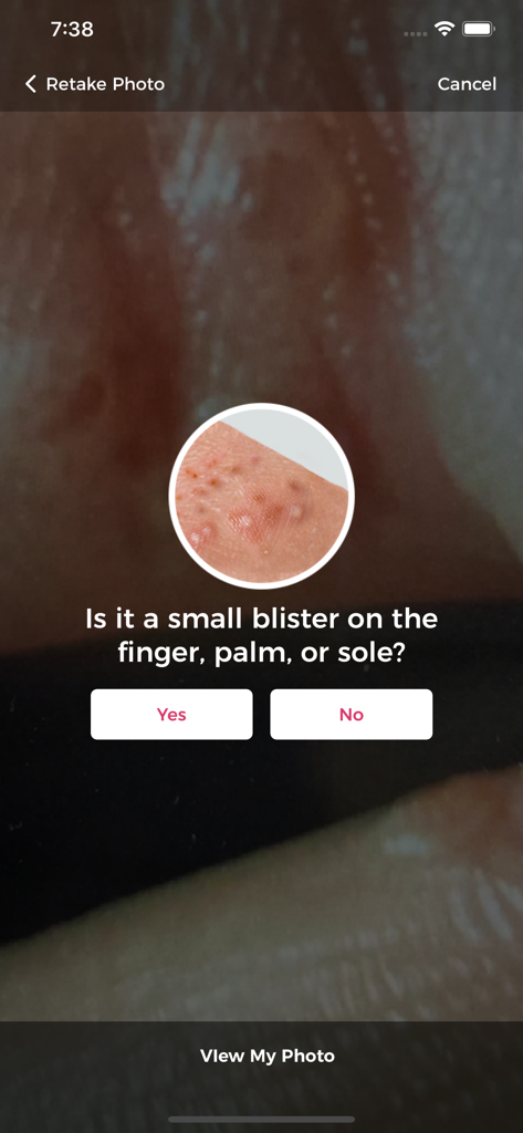 Aysa app screen asking a clarifying question about a skin symptom.