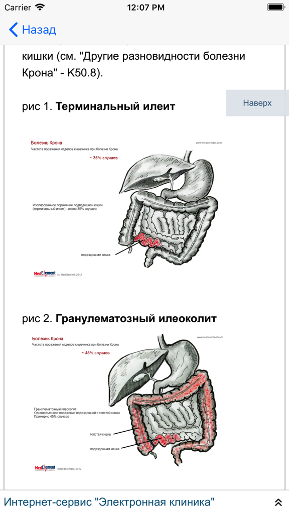 Anatomical diagrams showing types of Crohns disease including terminal ileitis in a Russian medical reference app
