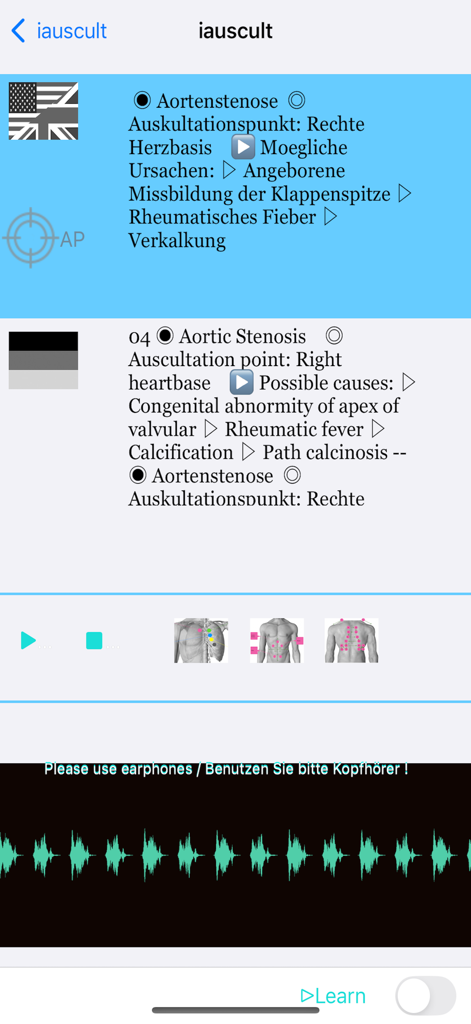 大動脈弁狭窄症の詳細な臨床ビュー。原因とオーディオビジュアライザーが含まれています。