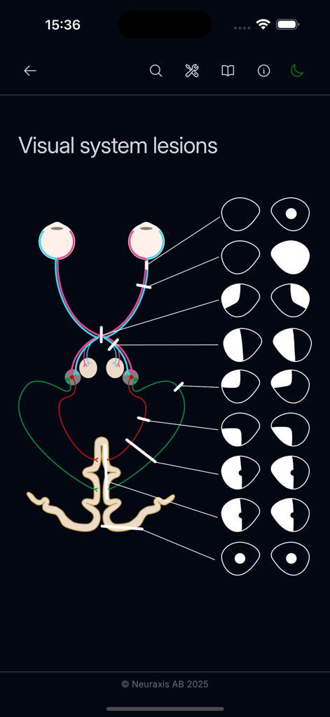 Ein medizinisches Diagramm, das Läsionen des visuellen Systems ihren entsprechenden Gesichtsfelddefekten in der Neuro Assistant App zuordnet