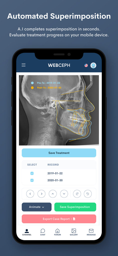 WebCeph - WebCeph mobile app interface showing automated AI superimposition of cephalometric X-rays to track dental treatment progress.