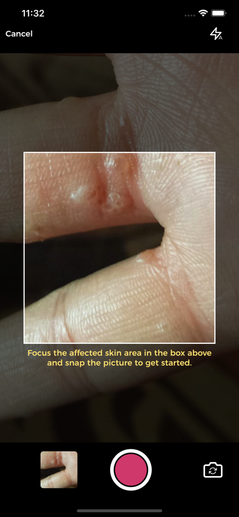 Interface da câmera do aplicativo móvel Aysa capturando uma foto de uma condição de pele para análise