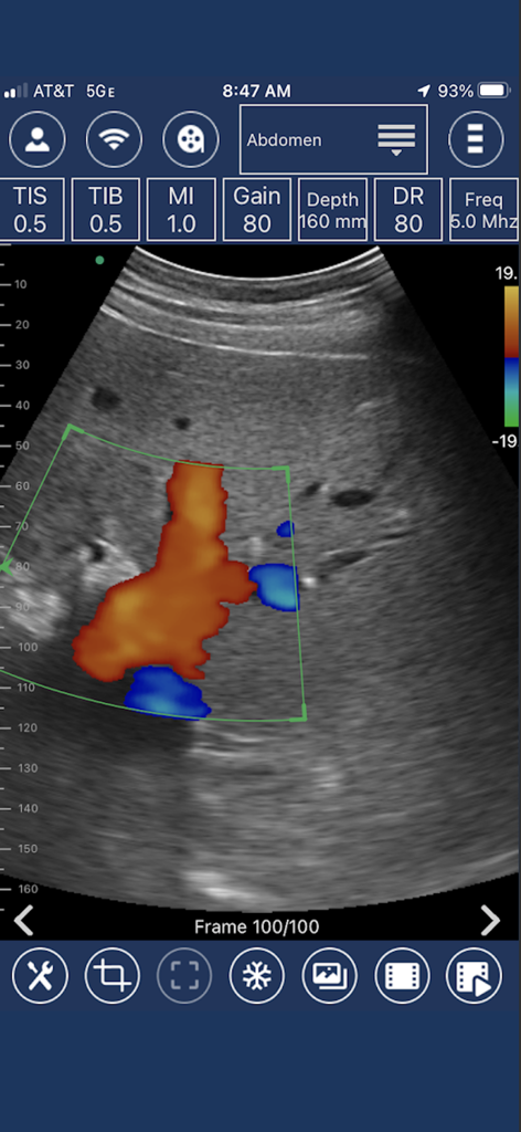EdgeLife - Interfaz de la aplicación móvil EdgeLife que muestra un escaneo de ultrasonido Doppler color del abdomen