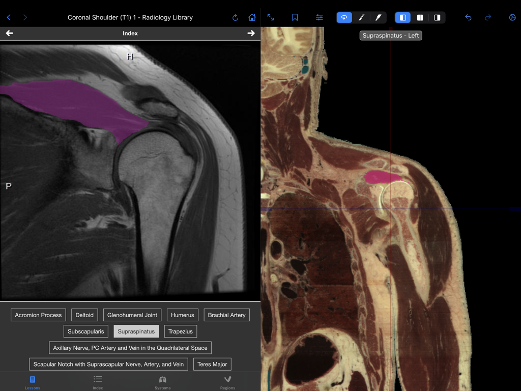 VH Dissector Pro - Side by side comparison of a coronal shoulder MRI and an anatomical cross section with the supraspinatus muscle highlighted in pink