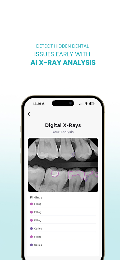 DentaSmart - Écran de l'application DentaSmart montrant l'analyse IA de radiographies dentaires identifiant les plombages et les caries